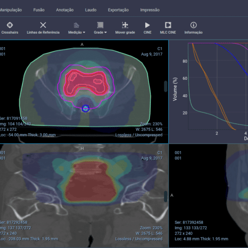 Calculating Monitor Unit (MU) in Radiation Therapy with Monte Carlo Algorithm