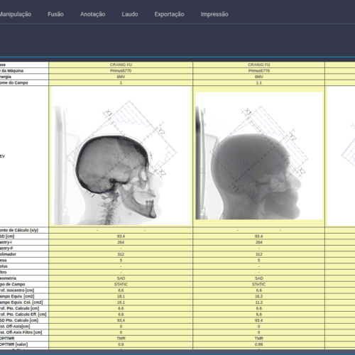 The Importance of Independent Secondary Verification in Radiation Therapy