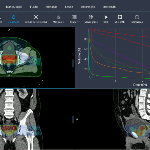 The Importance of Accurate Monitor Unit Calculations in Radiation Therapy