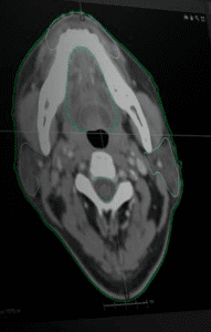 OAR RADIOTERAPIA