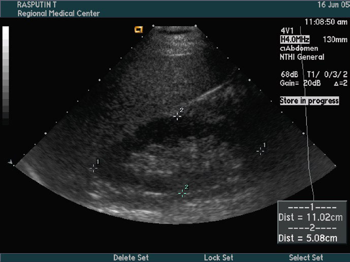 Imagem de ultrassom DICOM de abdome com medições de distância mostrando dados de paciente e parâmetros do equipamento