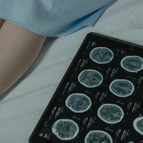 GPT-4o Ayuda a Diagnosticar Cáncer de Ovario por TC