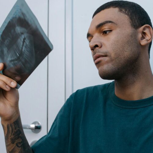 Raio-X de Tórax Revela Aterosclerose em Amputados