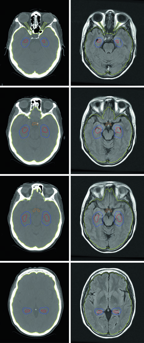 Hippocampal avoidance WBRT com fusão de CT e ressonância pós-contraste e expansão de 5 mm ao redor dos hipocampos
