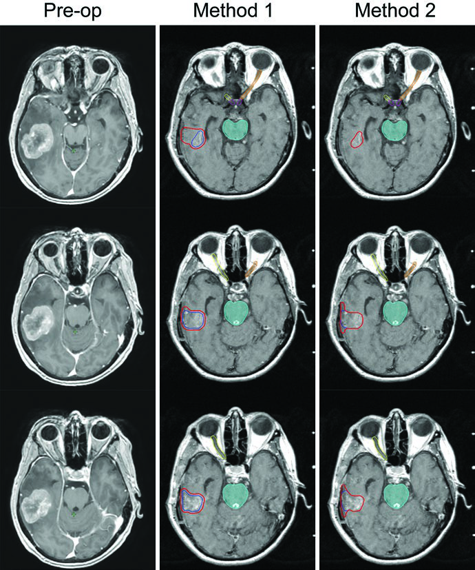 Metástases Cerebrais: WBRT, SRS e Delineamento