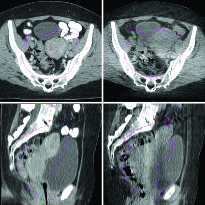 Radioterapia ginecológica avançada: IMRT e SBRT