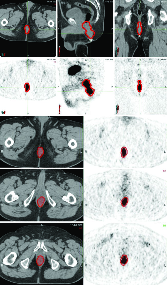 PET/CT co-registrado em cortes axial, sagital e coronal mostrando o GTV-P em câncer anal