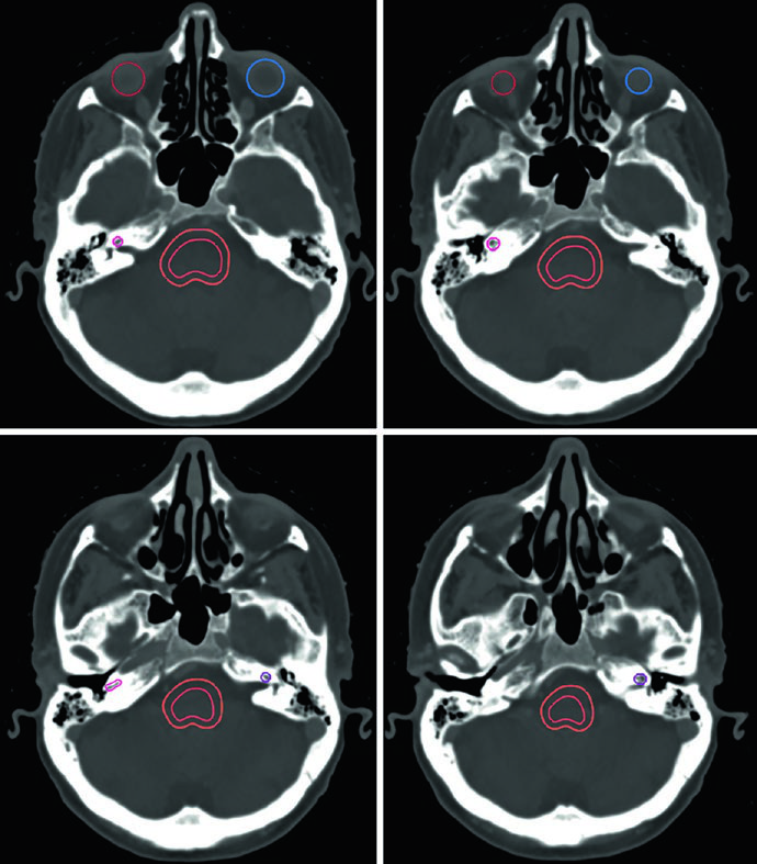 CT simulation in bone window identifying the right and left cochleae for intracranial radiotherapy treatment planning.