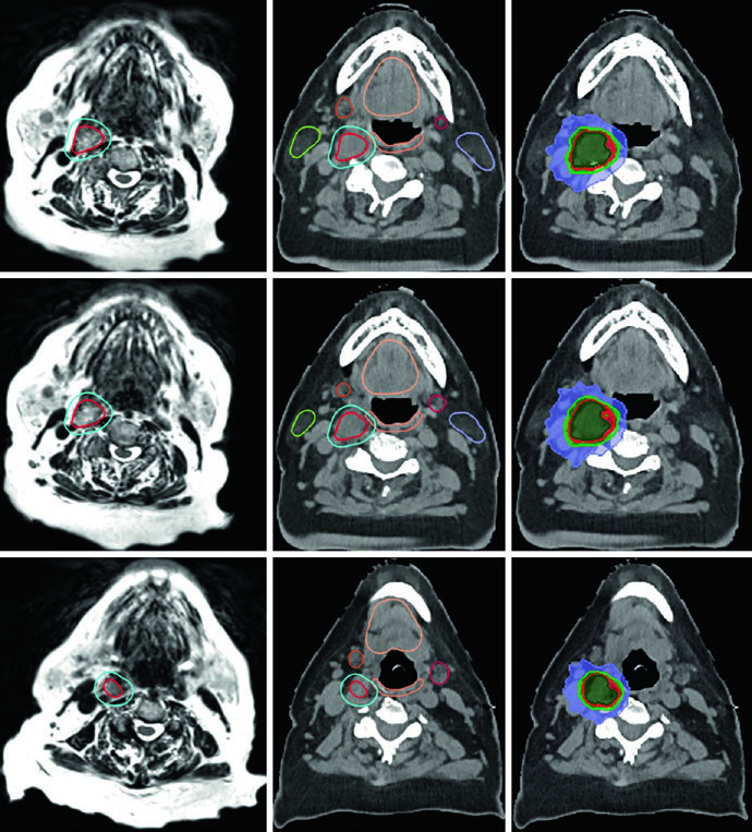Planning MRI, CT, and dose distribution for a right-sided glomus tumor at the carotid bifurcation treated with 25 Gy in 5 fractions.