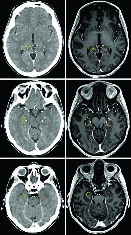 CT simulation and T1 post-contrast MRI used to contour the right and left hippocampus as the subgranular zone in treatment planning.
