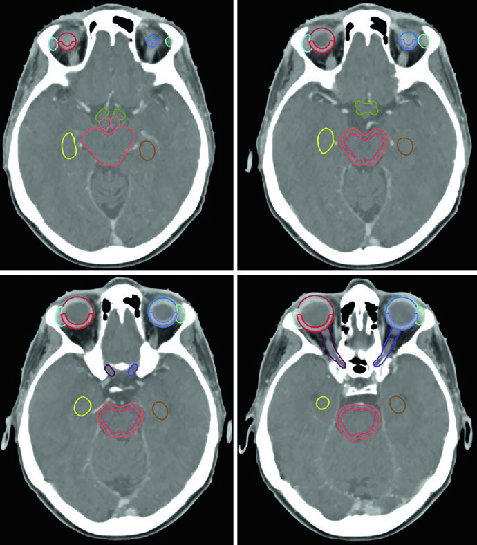 CT simulation in soft-tissue window highlighting the optic nerves through the optic canals, the globes, and the lacrimal glands for intracranial radiotherapy planning.