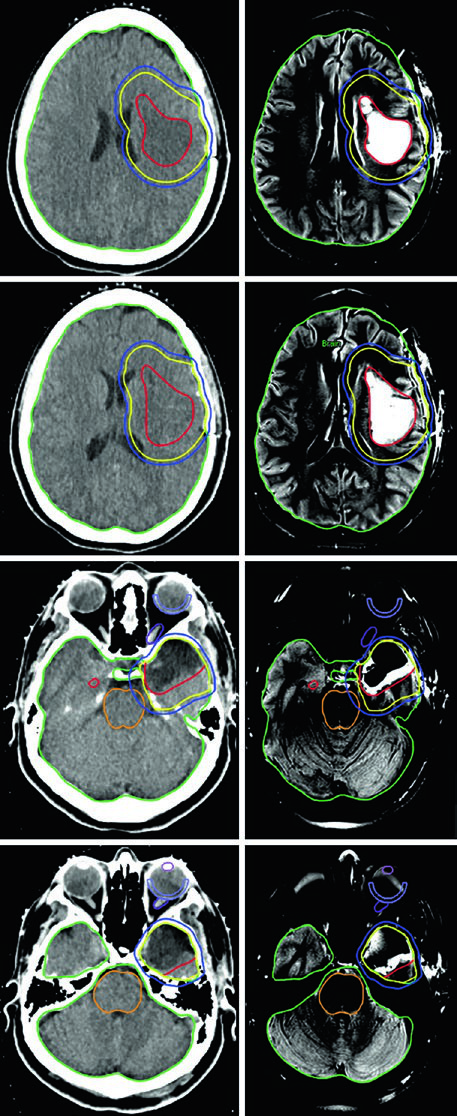 Treatment planning CT and post-contrast FLAIR MRI for an oligodendroglioma after partial resection with GTV, CTV, and PTV contours displayed.