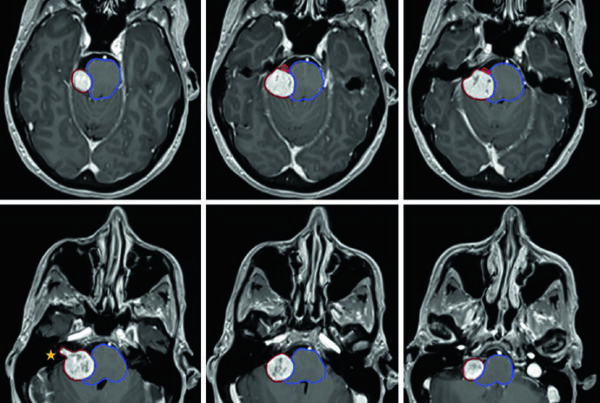 Axial T1 post-contrast planning MRI of a right cerebellopontine vestibular schwannoma with brainstem compression and extension into the internal auditory canal.