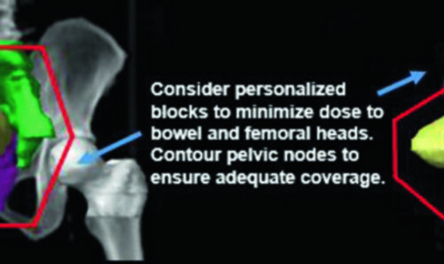 Câncer de Bexiga: Delineamento e Campos na RT