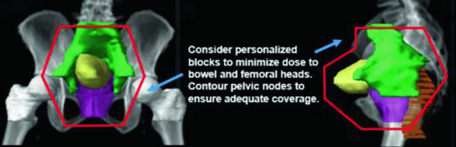 Cáncer de Vejiga: Delineación y Campos en RT
