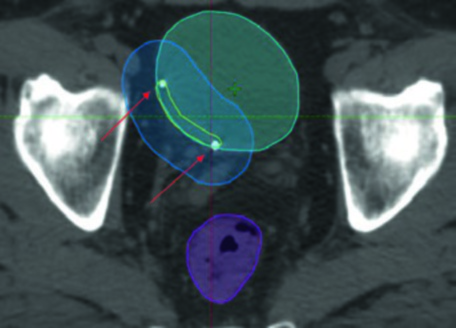 Corte axial de planificación IMRT para boost vesical mostrando vejiga en cian, lecho de TURBT en amarillo, PTV boost en azul, recto en magenta e intestino en verde, con flechas indicando fiduciales