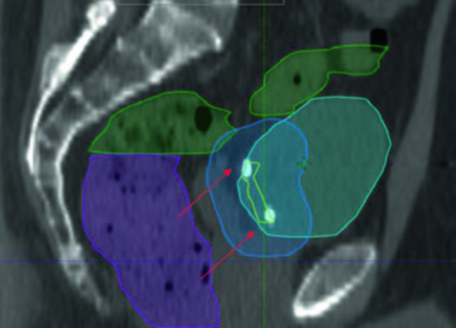 Corte sagital de planificación IMRT para boost vesical mostrando la relación espacial entre vejiga, lecho de TURBT, PTV boost, recto e intestino con fiduciales visibles