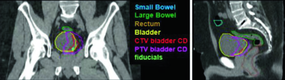 Cortes coronal y sagital del campo de boost vesical para paciente con cáncer de vejiga localmente avanzado T2N+ mostrando CTV y PTV del boost vesical con OARs delineados