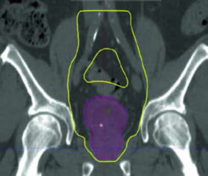 Corte coronal de planificación IMRT de campo pélvico inicial para cáncer de vejiga mostrando CTV vejiga en púrpura y expansión PTV en amarillo