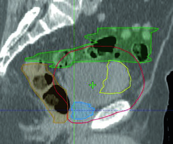 Vista sagital de IMRT bladder-only para paciente de 82 años con enfermedad músculo-invasiva localmente avanzada mostrando PTV en rojo, GTV en amarillo, intestino en verde y recto en naranja
