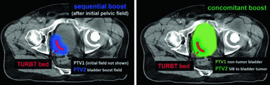 Representación esquemática de RHDVRT mostrando técnica de boost secuencial en dos fases versus boost integrado simultáneo (SIB) con lecho de TURBT en rojo y PTVs en azul y verde