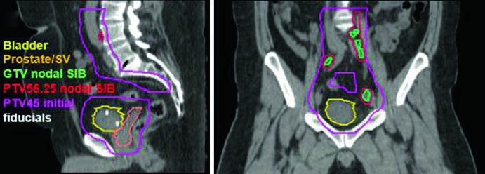 Cortes sagital y coronal de planificación IMRT con SIB para cáncer de vejiga ganglionar positivo mostrando vejiga en amarillo, GTV nodal SIB, PTV 56.25 nodal SIB y PTV 45 inicial en púrpura con fiduciales