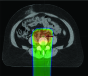 Distribuição de dose axial de IMRT com preservação de medula óssea para malignidade ginecológica pélvica