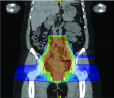 IMRT com preservação de medula óssea corte coronal mostrando distribuição de dose com preservação do campo pélvico