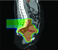 Distribuição de dose sagital de IMRT pélvica mostrando color wash de dose com preservação de medula óssea