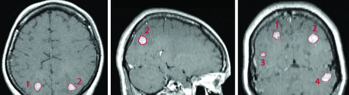 SRS de múltiplos isocentros com fração única para quatro metástases cerebrais de câncer de mama variando de 6 a 20 mm tratadas com Gamma Knife após WBRT prévia