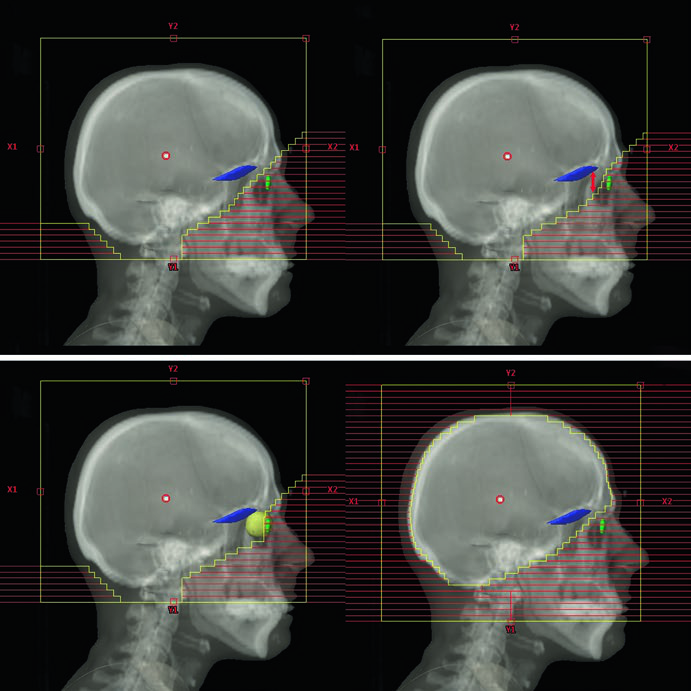 Variações dos campos padrão de WBRT para diferentes cenários clínicos: convencional, doença leptomeníngea, leucemia/linfoma de SNC e técnica scalp-sparing