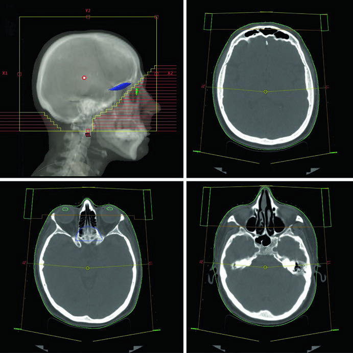 Metástases Cerebrais: WBRT, SRS e Delineamento