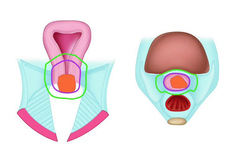 Volumes-alvo de braquiterapia guiada por imagem segundo GEC-ESTRO: GTV, HRCTV e IRCTV em diagrama esquemático do colo uterino