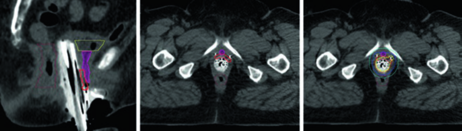 Câncer vaginal distal com implante intersticial: corte sagital com HRCTV e aplicador, corte axial e distribuição de dose