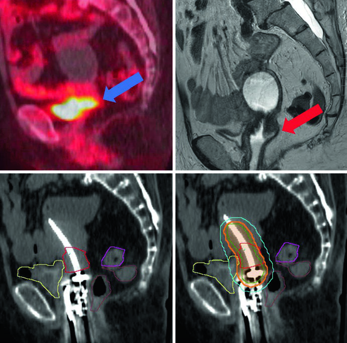 Braquiterapia Guiada por Imagem: Planejamento