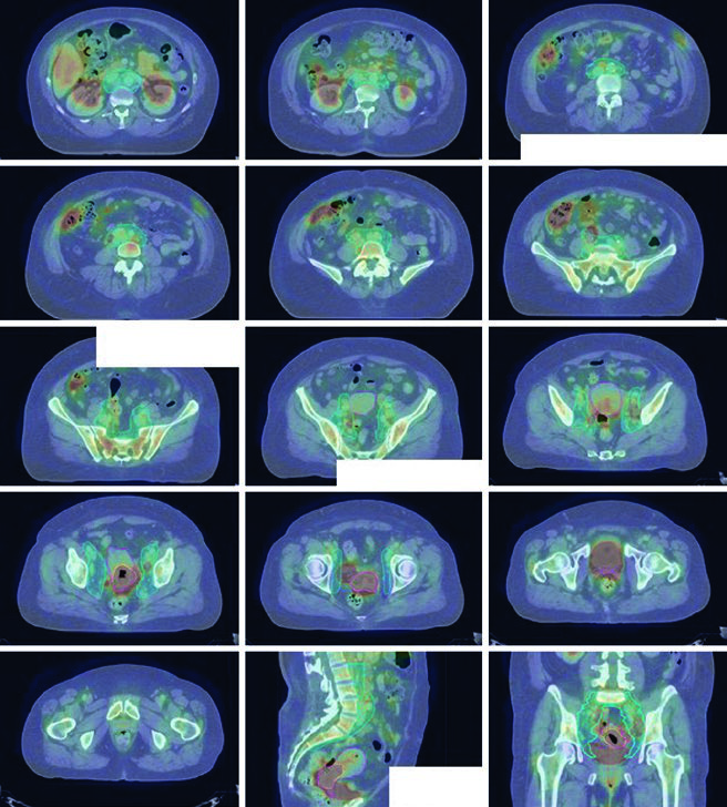 Simulacao de carcinoma cervical FIGO IIIC2 com doenca parametrial e linfonodos para-aorticos positivos mostrando GTV, GTV nodal, CTV1, CTV2 e CTV3