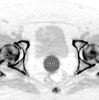 Corte axial de TC com cilindro vaginal para braquiterapia apresentando gap de ar entre o aplicador e a cúpula vaginal