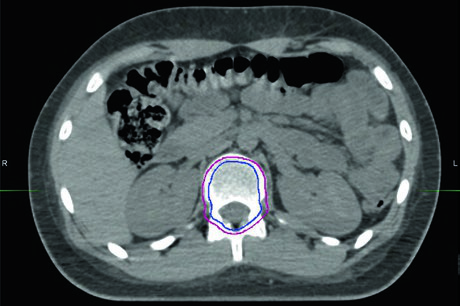 TC de planificación en ventana ósea mostrando CTV espinal incluyendo el cuerpo vertebral completo en un niño en crecimiento