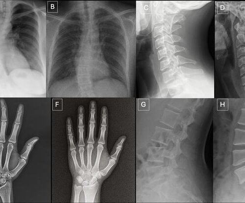 Deepfakes de Raio-X Enganam Radiologistas e IA, Diz Estudo