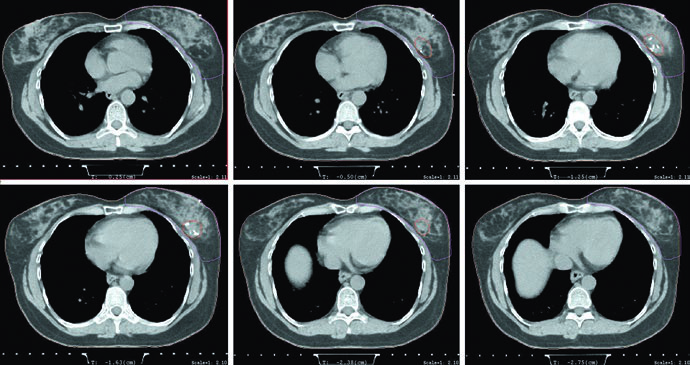 Axial CT images in the supine position for a woman with left-sided stage I breast cancer.