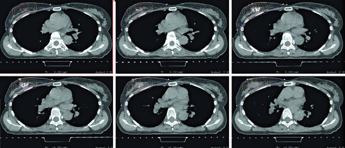 Axial APBI planning images showing lumpectomy cavity, CTV expansion, and PTV expansion around the cavity.
