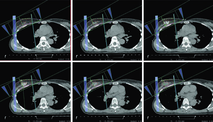 APBI plan using mini-tangent photon fields combined with an en face electron field.