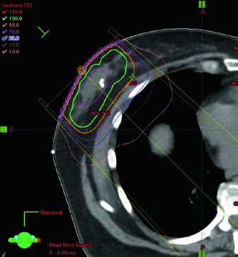 Tumor bed boost in the supine position with 12 MeV electrons covering the 90 percent isodose line to the anterior surface of the pectoralis muscle.