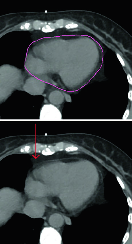 Heart contour including the pericardium while excluding pericardial fat outside the pericardium.