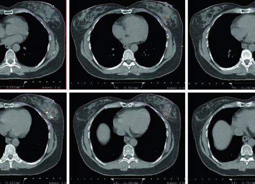Câncer de Mama Inicial: Delineamento e Campos