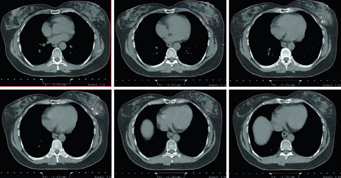 Câncer de Mama Inicial: Delineamento e Campos