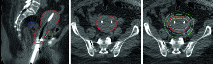 Câncer de endométrio inoperável com aplicador Y para braquiterapia: corte sagital com HRCTV, corte axial e distribuição de dose