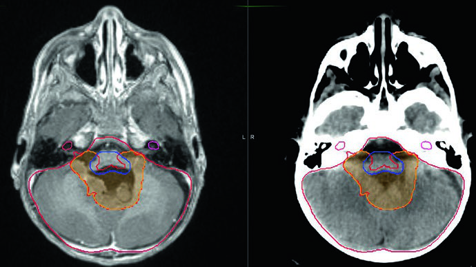 Cortes axiales de RM y TC mostrando CTV 54 Gy con extensión de 3 mm en el tronco cerebral y CTV 59,4 Gy excluyendo completamente el tronco en ependimoma infratentorial con compromiso bilateral de los forámenes de Luschka