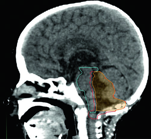 Corte sagital de TC mostrando CTV 59,4 Gy recortado sobre el foramen magno y CTV 54 Gy extendiéndose por el foramen magno en ependimoma infratentorial