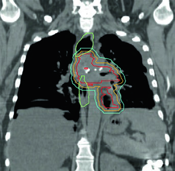 Coronal thoracic target delineation figure from the book